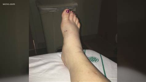 North Carolina woman recovering after venomous snake bite | 13newsnow.com