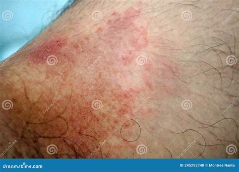 Itchy Rash in the Groin Area. Tinea Cruris is a Type of Skin Disease that Occurs in the Groin ...