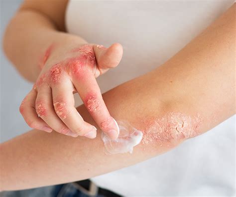 Weeping Eczema: Symptoms, Causes, and Treatment