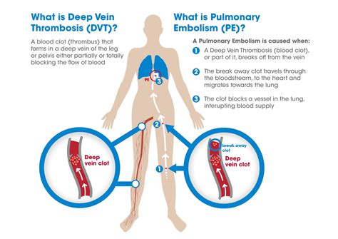 Venous Thromboembolism (DVT/PE)- Facts – The Operating Room Global (TORG)