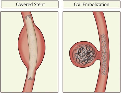 Coronary Artery Aneurysms, Arteriovenous Malformations, and Spontaneous ...