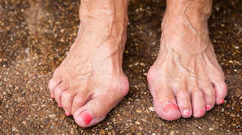 Hallux valgus: causes, prevention, treatment | gesund.bund.de