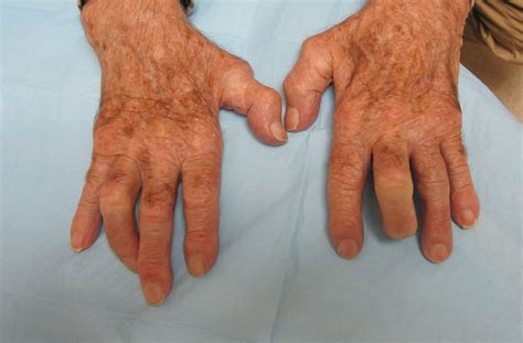 Osteoarthritis Nodules On Finger Joints