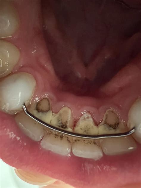 Trouble cleaning around permanent retainer (bottom teeth) : r/Teeth