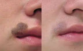 Laser mole removal scar | Laser mole removal, Mole removal, Skin moles