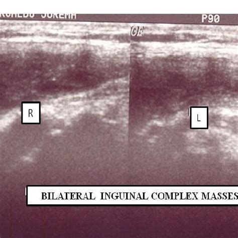 Inguinal Ultrasound showing both bilateral inguinal complex masses ...