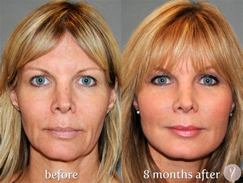 Facelift Surgery: 5 Useful and Significant facts