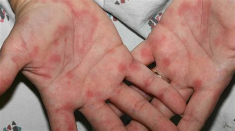 0 Result Images of Why Are There Red Dots On My Hands - PNG Image Collection