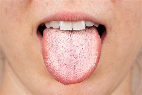 11 Reasons For A White Tongue & Treatments