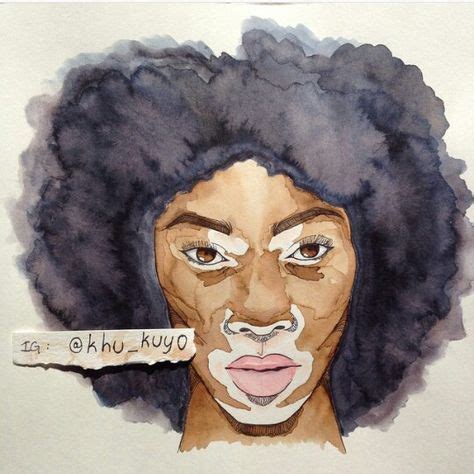 62 Vitiligo Art ... Faces ideas | vitiligo, art, vitiligo treatment