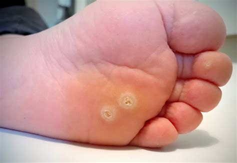 PLANTAR WART TREATMENT | PLANTAR WART DOCTOR IN PLANO