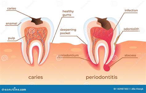 Unhealthy Teeth Stand in Raw in Gums. Tooth Decay. Stock Vector - Illustration of infection ...