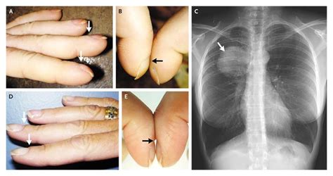 New-Onset Clubbing Associated with Lung Cancer | NEJM