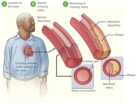 Coronary Artery Disease Pathophysiology Diagram
