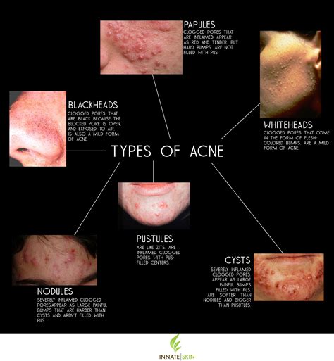 Acne Types: How to Recognize What Kind of Acne You Have | Types of acne ...