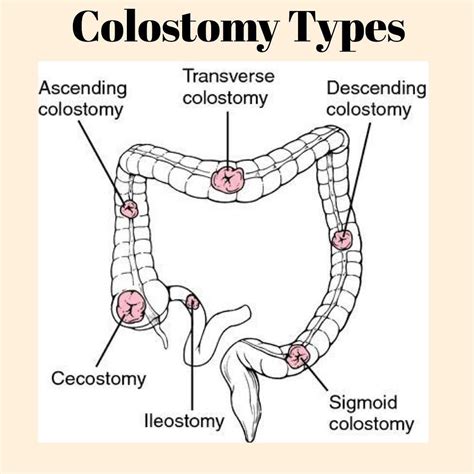 olostomy Types . . . Colostom