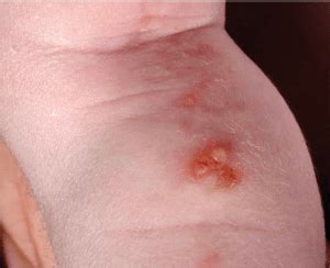 Spongiotic Dermatitis: Symptoms, Treatment & Prevention