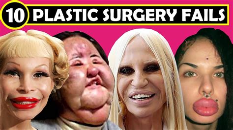 TOP 10 BOTCHED PLASTIC SURGERY FAILS - ( Plastic Surgery Before and ...