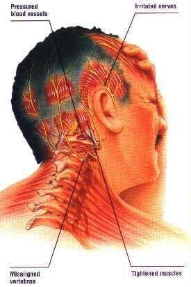 Neck Pain Headache (Causes & Treatments) - INTEGRATIVE PHYSIO