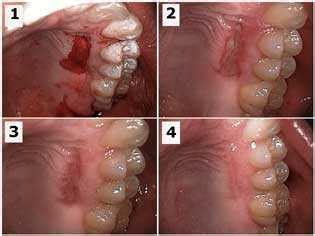 Mucogingival involvement and attached gingiva