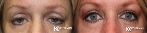 Ptosis Before & After Gallery | Plastic Surgery with Dr. Kopelman