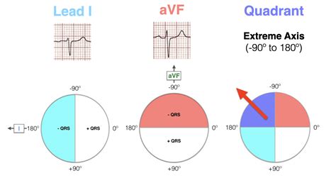 ECG Axis Interpretation • LITFL • ECG Library Basics