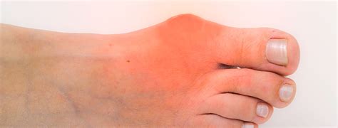 Gout Treatment and Gout Attack Pain Relief -- Northwest Indiana Podiatrist