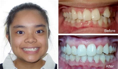 Crossbite Treatment Options: Braces, Invisalign, and More