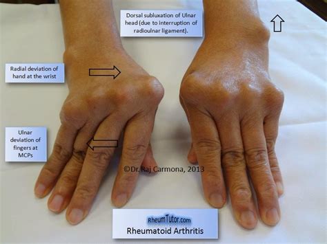 144 PENYAKIT: ARTHRITIS REUMATOID