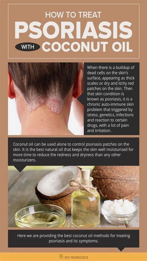 Psoriasis Diet - How to Treat Psoriasis with Coconut Oil - #DIY # ...