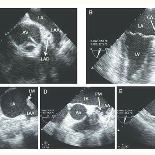 Left atrial appendage evaluation by transoesophageal echocardiography ...