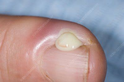 Paronychia infection of the finger - Stock Image - C009/0030 - Science ...