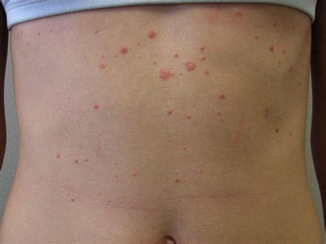 Mild Psoriasis: Types, Symptoms, and Treatment