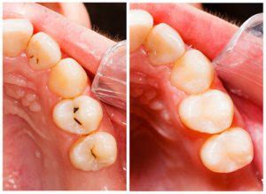 5 Options For Tooth Restoration — Dental Care Resources