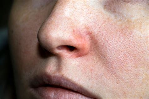 Piel seca en la cara: causas, síntomas y tratamiento