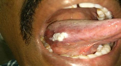 Table 2 from An observational study of benign oral lesions in central ...