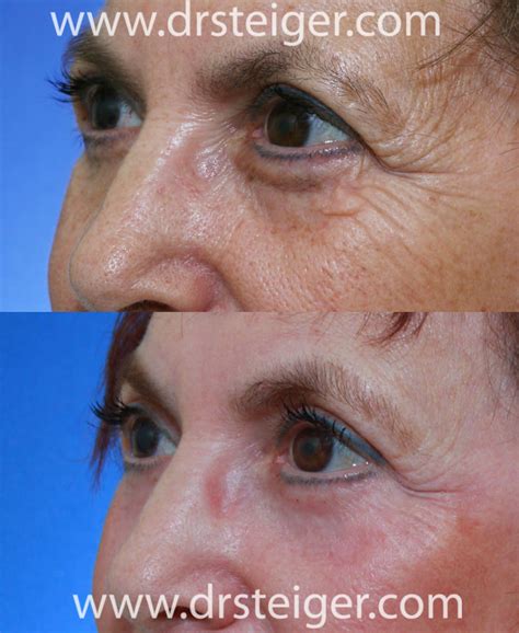 Under Eye Laser Treatment For Wrinkles - Quotes Type