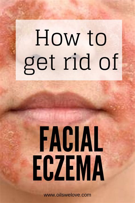 Eczema treatment for face 185323-Best eczema treatment for babies face
