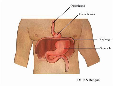 Hiatal Hernia Surgery – chennaihernia.com