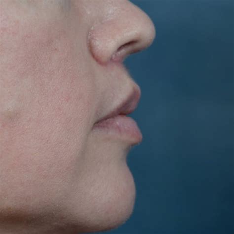 Patient 6157746 | Lip Lift Before & After Photos | Starkman Facial Plastic Surgery