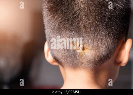 The lacerated sutured wound of kid back head which suture by nylon suture about 3 stitches at ...