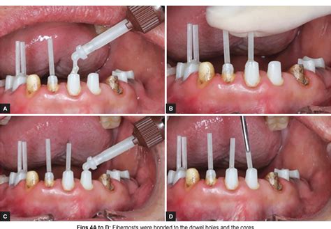 Pre-endodontic Post and Core Technique for Endodontic and Prosthodontic ...