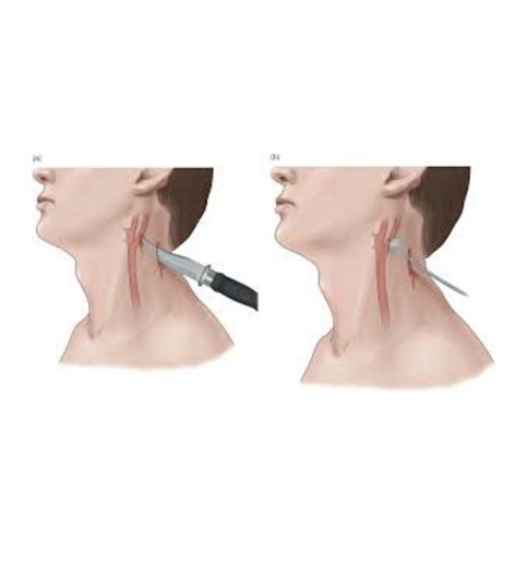 NECK TRAUMA: The penetrating pain - Health Emergency Initiative