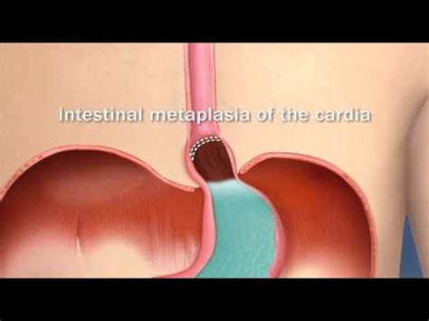 Metaplasia intestinal: sintomas, tratamento e dieta - Saúde - 2023