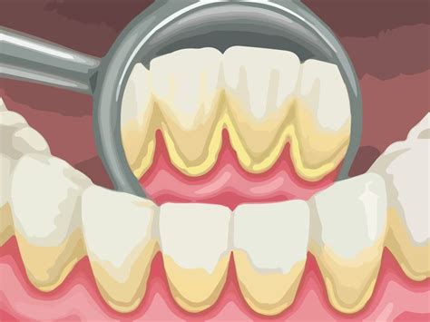 remove-dental-plaque-and-tartar-3 | Kuipers Ortho