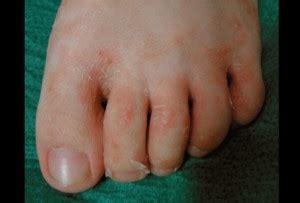 👉 Tinea Pedis - Treatment, Pictures, Symptoms and Causes (December 2021)