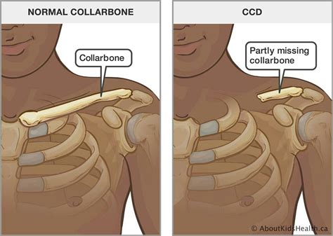 Cleidocranial Dysplasia | Genetic disorders, Dental problems, Dental ...