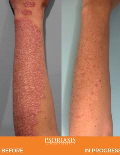 Psoriasis Specialist Gallery - Psoriasis Clinics Australia