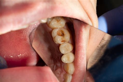 7 Early Signs of a Cavity Forming in Your Teeth - Cian Blog