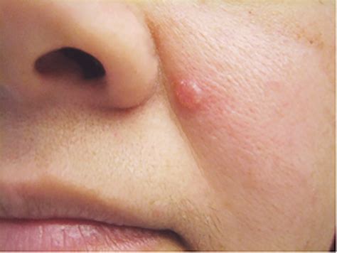 Skin Cancer White Spots On Face - CancerWalls